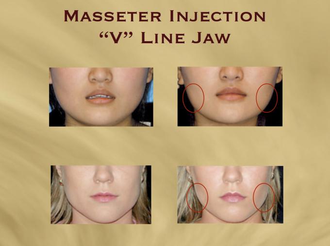 V-Line Masseter Injection with Botox® (&quot;Square Jaw&quot; reduction) - Aesthetics  Hawaii