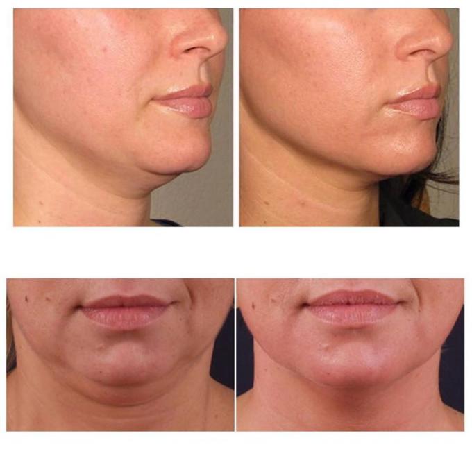 1500 Units Hyaluronic Acid Filler Dissolve 10 Vials Liporase Injection