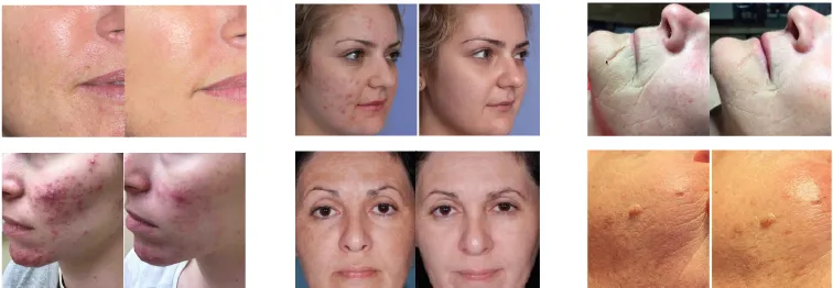 LED Facial Light Infrared LED Therapy PDT LED Professionele Machine Bio Photomodulation LED Phototherapy Light 4