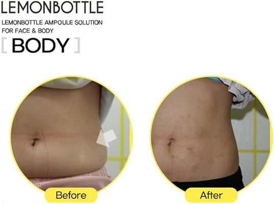Lemon Bottle 10ml*5 Dissolves Excess Fat and Loses Weight Lipolab Kabelline